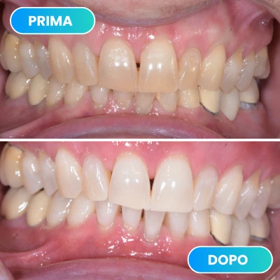 Prima e dopo trattamento odontoiatrico con miglioramento dell'allineamento e dello sbiancamento dentale svolto dalla dott.ssa Erica Lorenzini Odontoiatra a Firenze