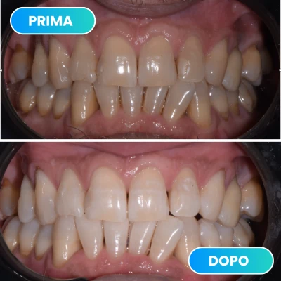 Correzione di problemi dentali con trattamento ortodontico e sbiancamento svolto dalla dott.ssa Erica Lorenzini Odontoiatra a Firenze