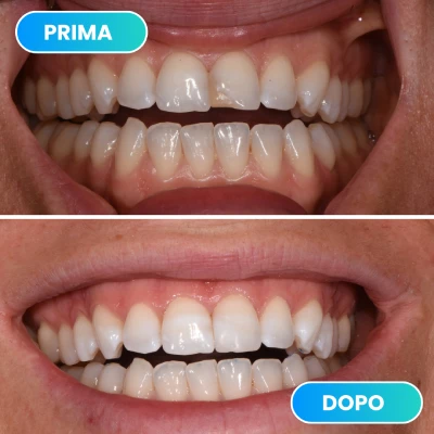 Prima e dopo trattamento di sbiancamento e allineamento dentale per un sorriso luminoso svolto dalla dott.ssa Erica Lorenzini Odontoiatra a Firenze