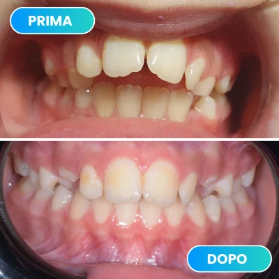 Correzione ortodontica per allineare i denti e migliorare l'estetica del sorriso svolto dalla dott.ssa Erica Lorenzini Odontoiatra a Firenze