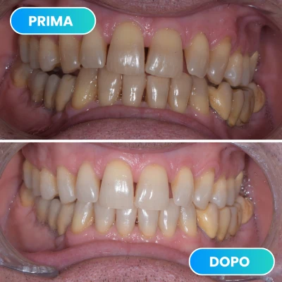 Correzione di dentatura irregolare con evidenti benefici estetici svolto dalla dott.ssa Erica Lorenzini Odontoiatra a Firenze