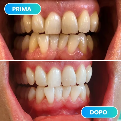 Prima e dopo trattamento odontoiatrico per sbiancamento e allineamento dentale svolto dalla dott.ssa Erica Lorenzini Odontoiatra a Firenze